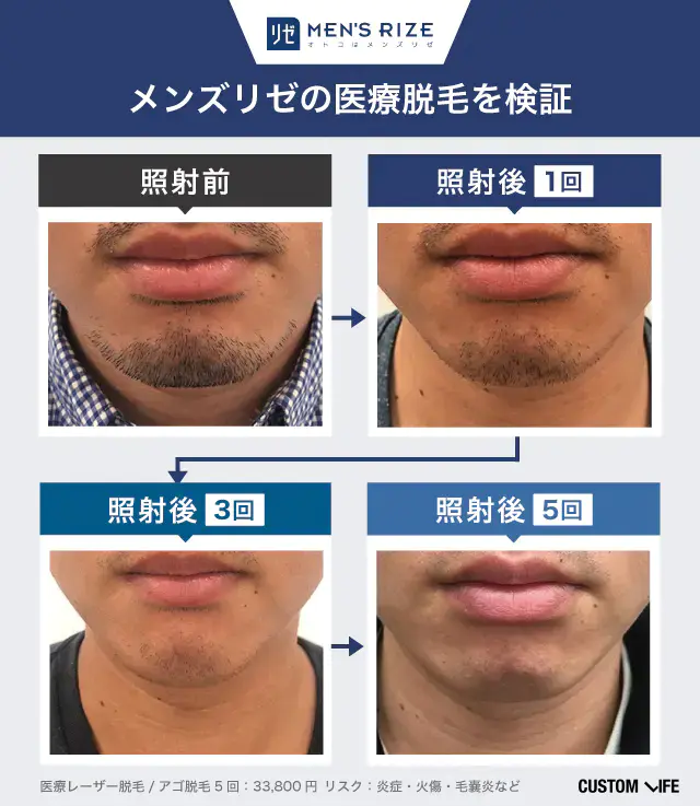 メンズリゼの脱毛効果を編集部員が実際に受けて検証