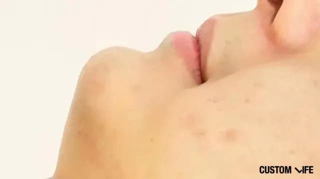 脱毛から3日後(あご横)