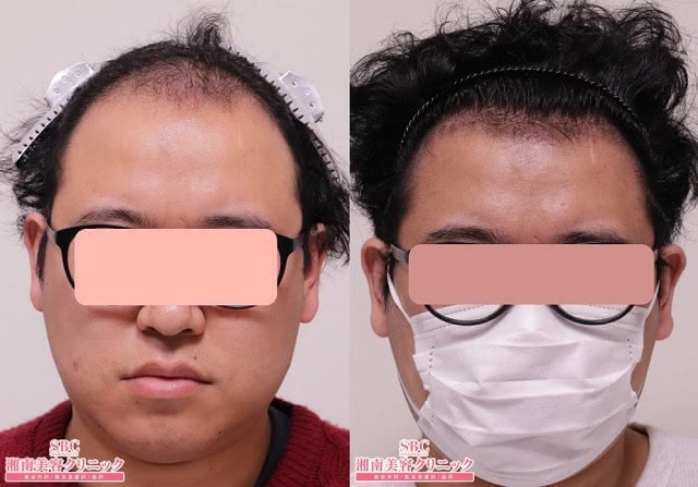 湘南美容クリニックのAGA治療効果