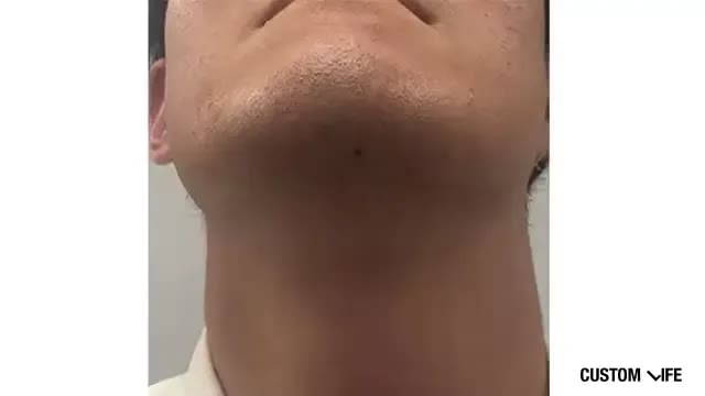 メンズリゼであご下を脱毛した人1回目