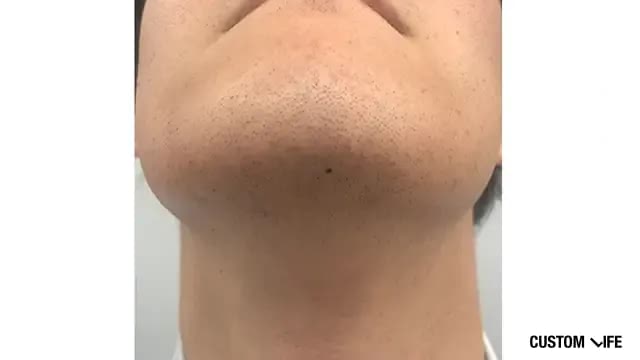 メンズリゼであご下を脱毛した人3回目