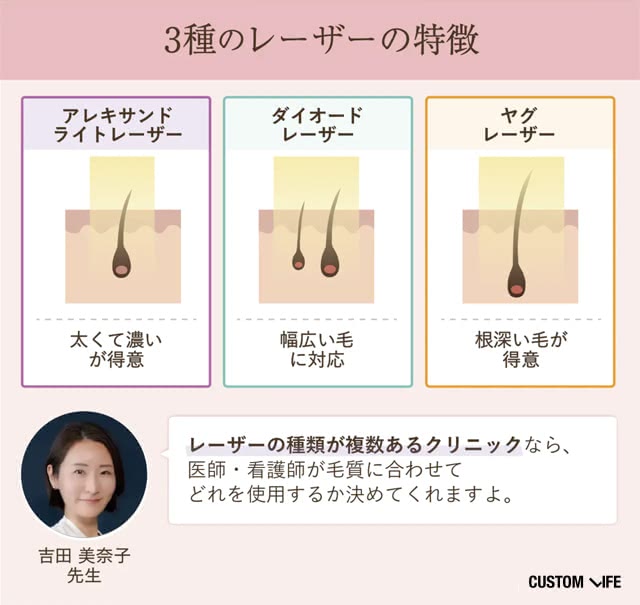 3種類のレーザーの特徴
