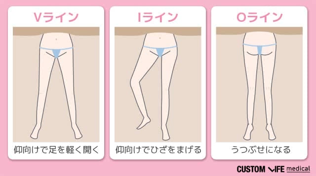 VIOの照射方法