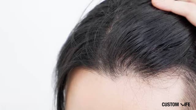薄毛を心配する男性の頭皮