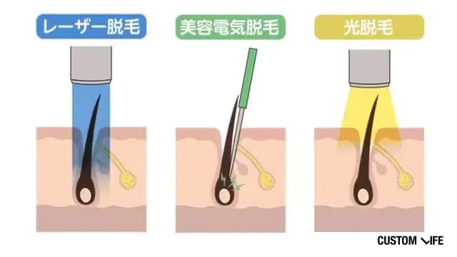 ヒゲ脱毛が痛い脱毛方法