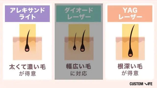 レーザー3種類の比較
