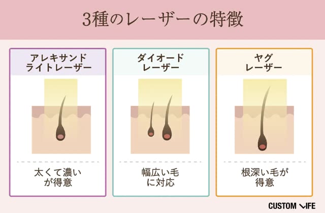 脱毛機の種類