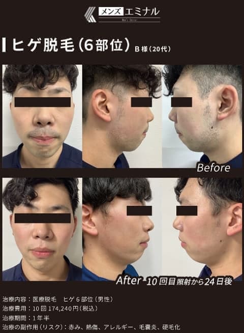 エミナルクリニックメンズの医療脱毛効果を検証