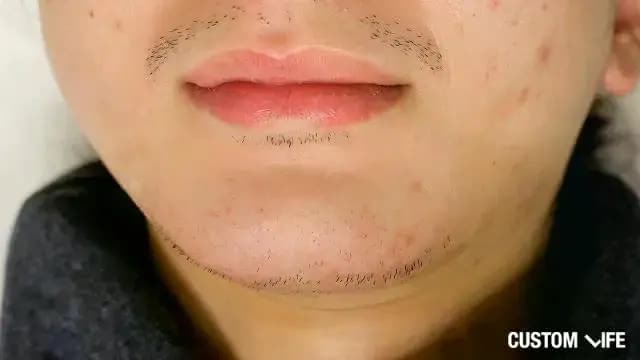 メンズTBCでヒゲ脱毛した編集部員のafter