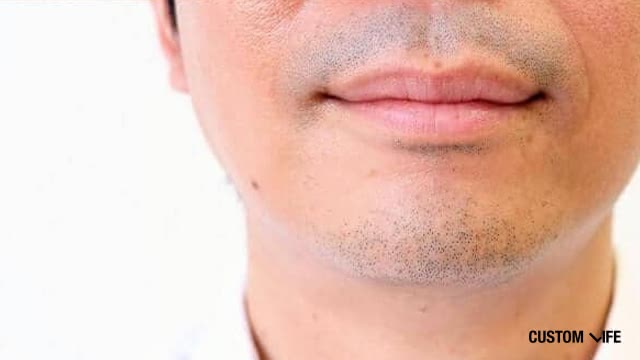 ヒゲ脱毛する前の青髭男性
