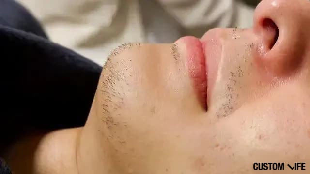 脱毛直前beforeあご横