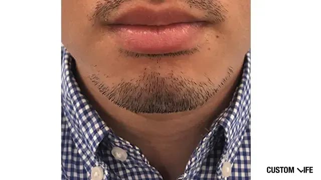 メンズリゼであごを脱毛した人ビフォー