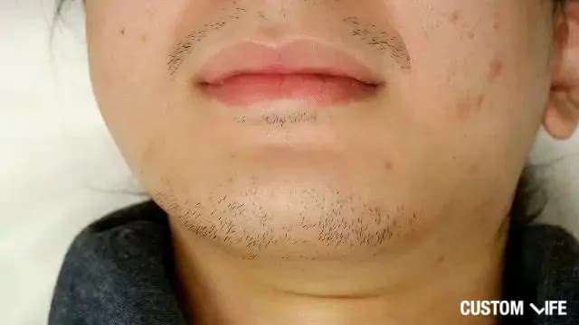 脱毛直前beforeあご