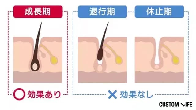 ヒゲ 永久脱毛 毛周期