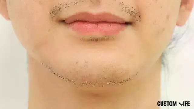 脱毛から1週間後(あご)