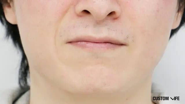 16回目の脱毛から1か月経過したヒゲ