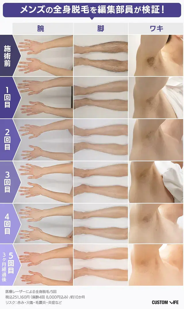 編集部員がメンズ全身脱毛5回通った効果検証画像