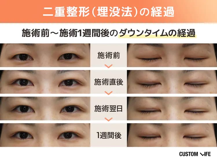 カスタムライフmedical編集部員の二重整形のダウンタイムの様子