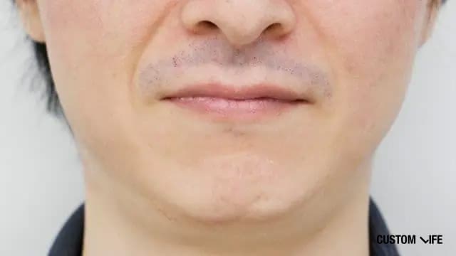 16回目の脱毛直後のヒゲ