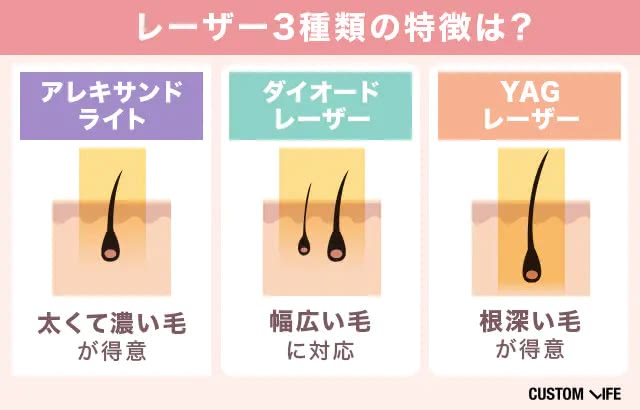 レーザーの種類一覧