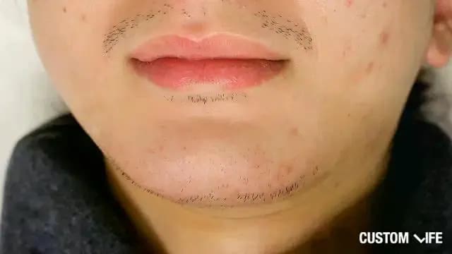 脱毛直後(あご)
