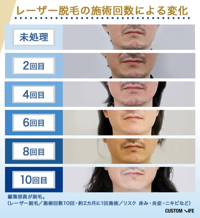 医療レーザー脱毛によるヒゲの変化