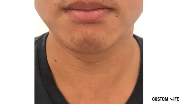 メンズリゼであごを脱毛した人3回目