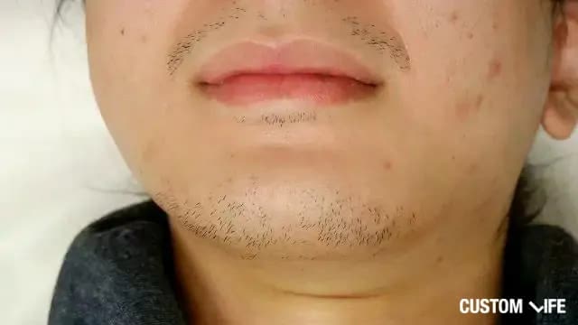 メンズTBCでヒゲ脱毛した編集部員のbefore