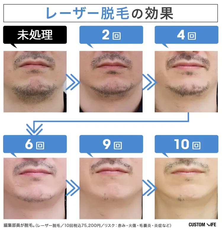 医療脱毛で10回ヒゲ脱毛をした編集部員のビフォーアフター症例