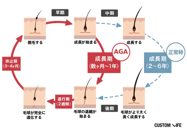 AGAを発症する仕組みのイラスト