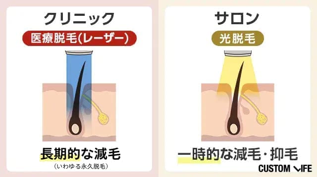 クリニックは永久脱毛、サロンは減耗や抑毛ができるイラスト