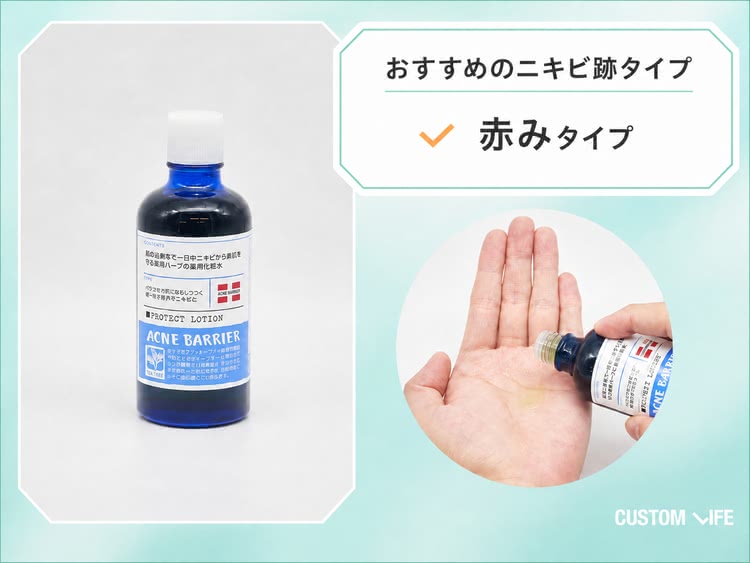 ニキビ跡,化粧水,アクネバリア