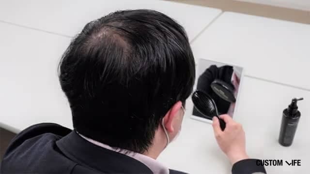 つむじはげの特徴