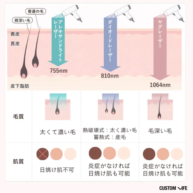 レーザーの違い