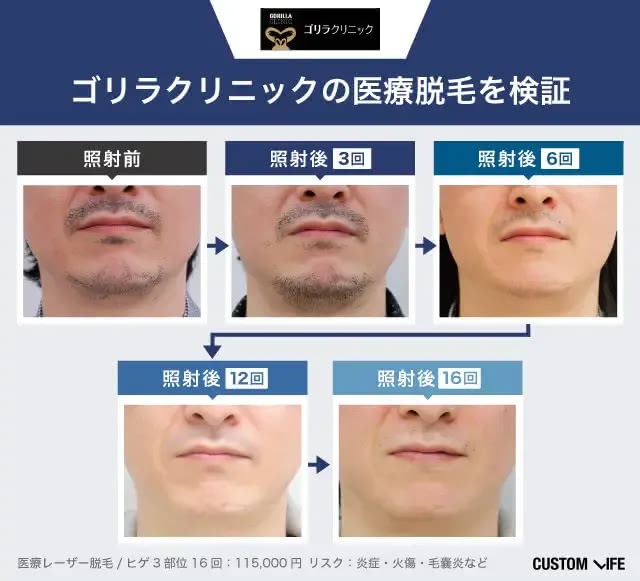 ゴリラクリニックの脱毛効果を編集部員が実際に受けて検証