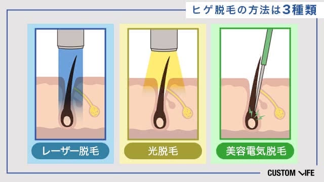 ヒゲ脱毛の方法一覧