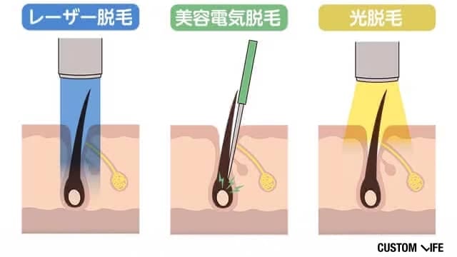 ヒゲの脱毛方法の効果の違い