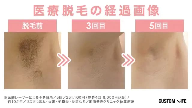 医療脱毛の経過画像