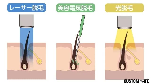 脱毛の種類を説明する画像
