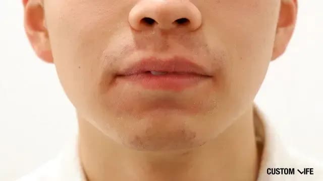 レーザー脱毛後(鼻下・あご)