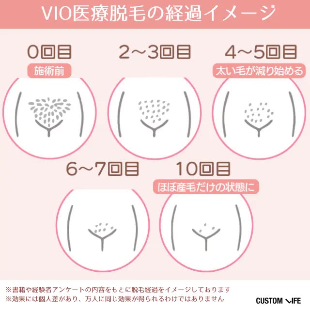 VIO脱毛の経過
