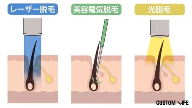 レーザー脱毛、美容電気脱毛、光脱毛の違いのイラスト