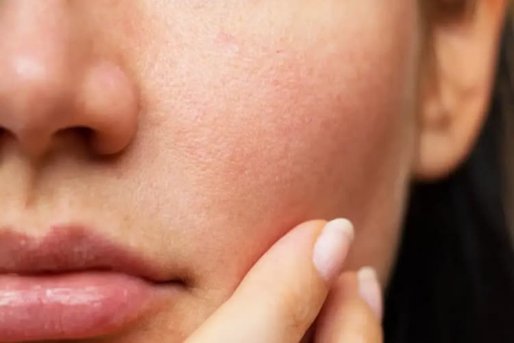脂漏性皮膚炎とは？敏感肌の長引く皮脂トラブルの原因&正しい対策を全解説