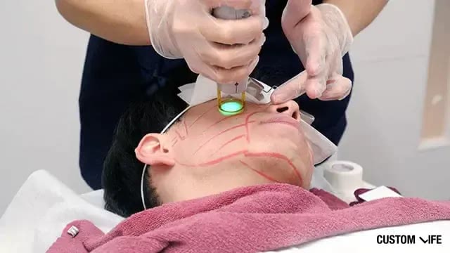 メンズリゼで右頬をレーザー脱毛中