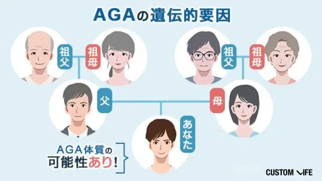 AGAが遺伝する家系図