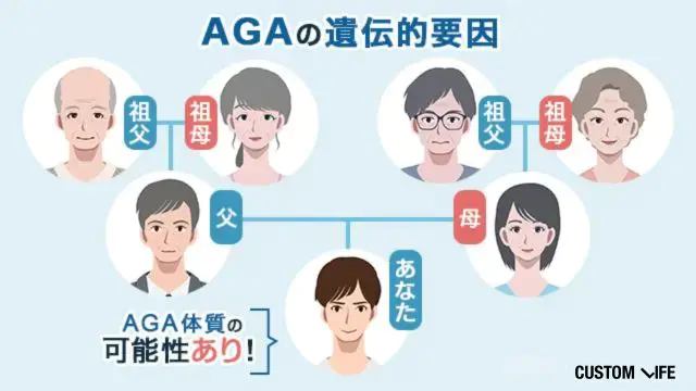 AGAが遺伝するイメージ画像