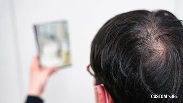 抜け毛の増加に悩む男性