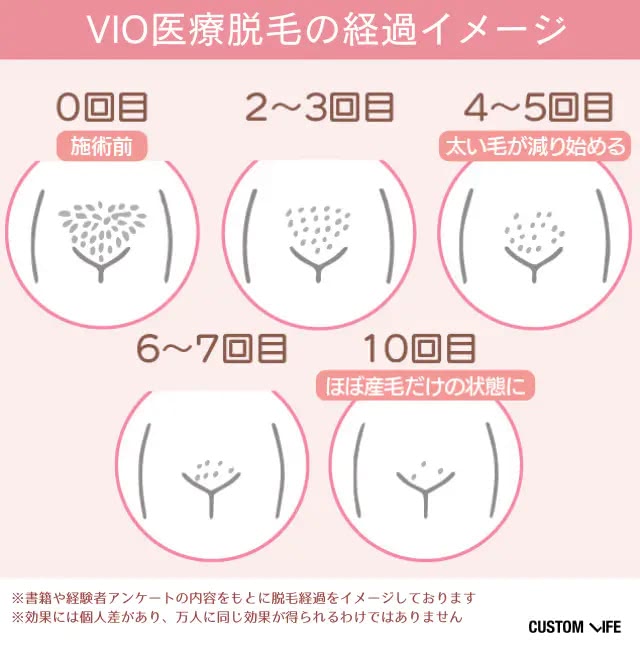 VIO医療脱毛の経過