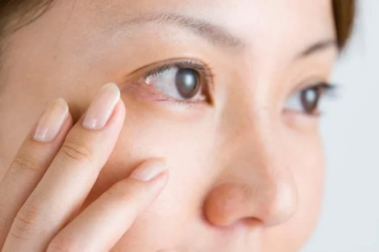 目元にシミができる原因とは？効果的な美白化粧品＆皮膚科治療で徹底対策