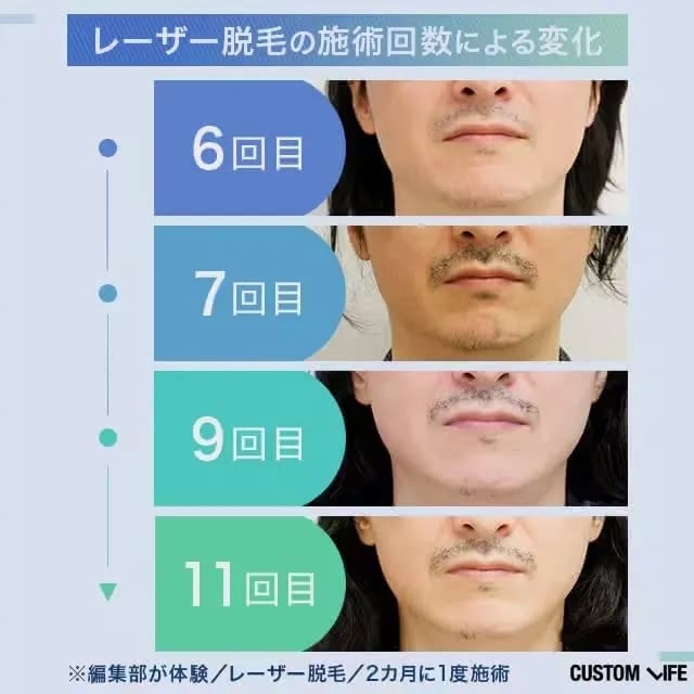 医療レーザー脱毛によるヒゲの変化
